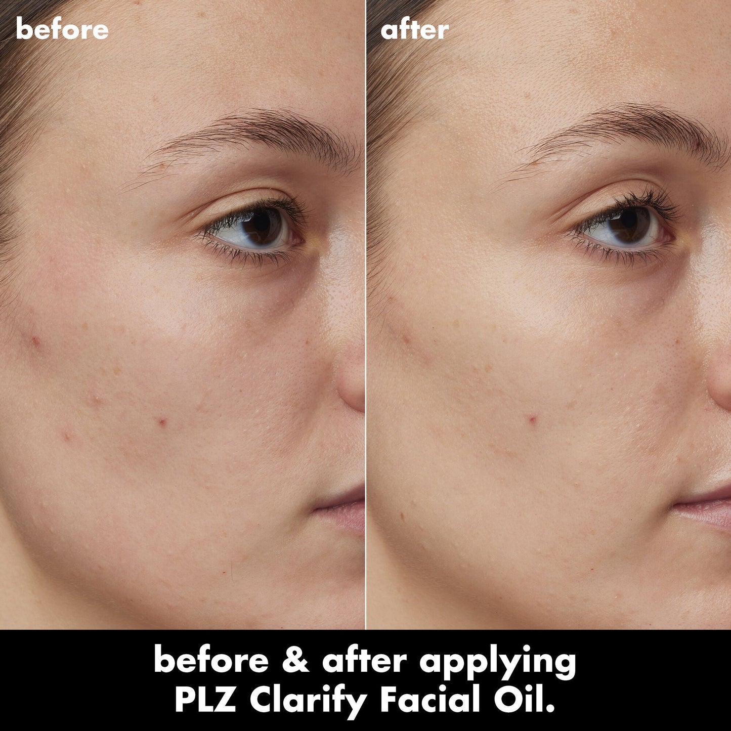 plz-clarify-facial-oil-y0 0326_EDU_PlzClarify_BA_Kelly.jpg