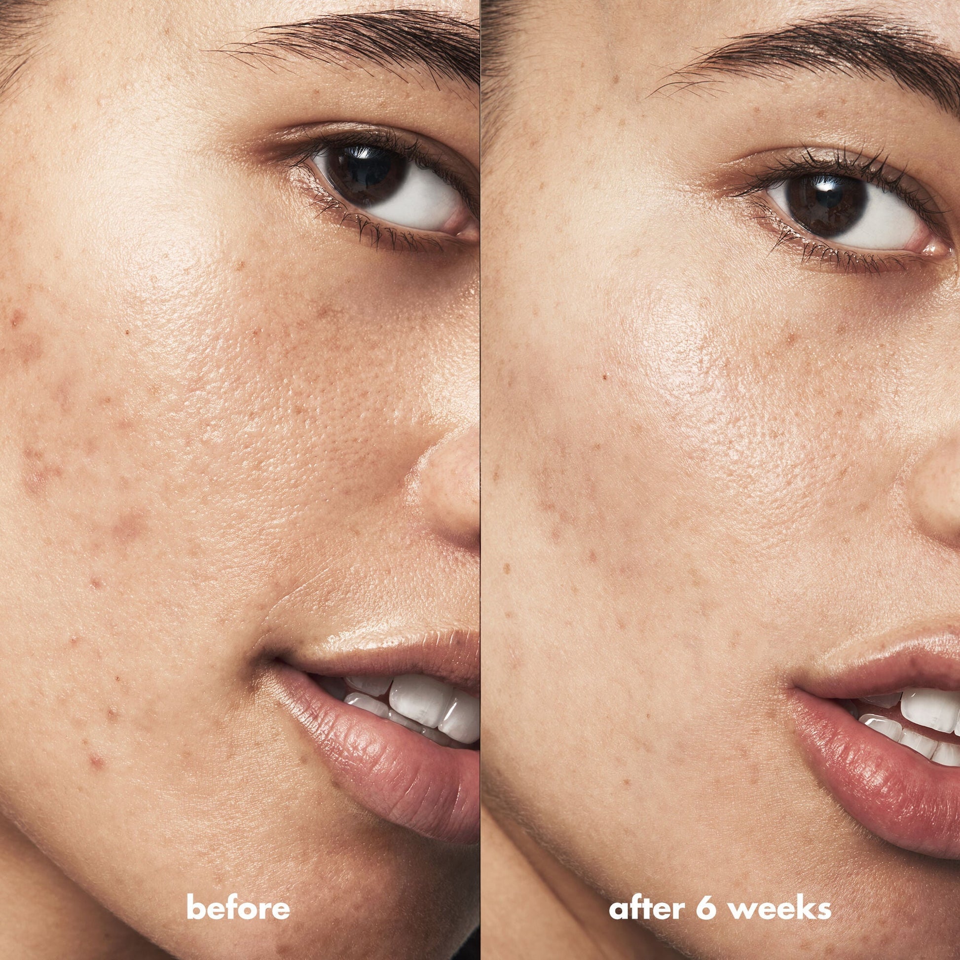 blemish-breakthrough-blemish-control-basics-kit-f1 Acne_PDP_Isabella_Before_After_0fcb9356-ae60-4e94-8953-6b1b2219dc49.jpg