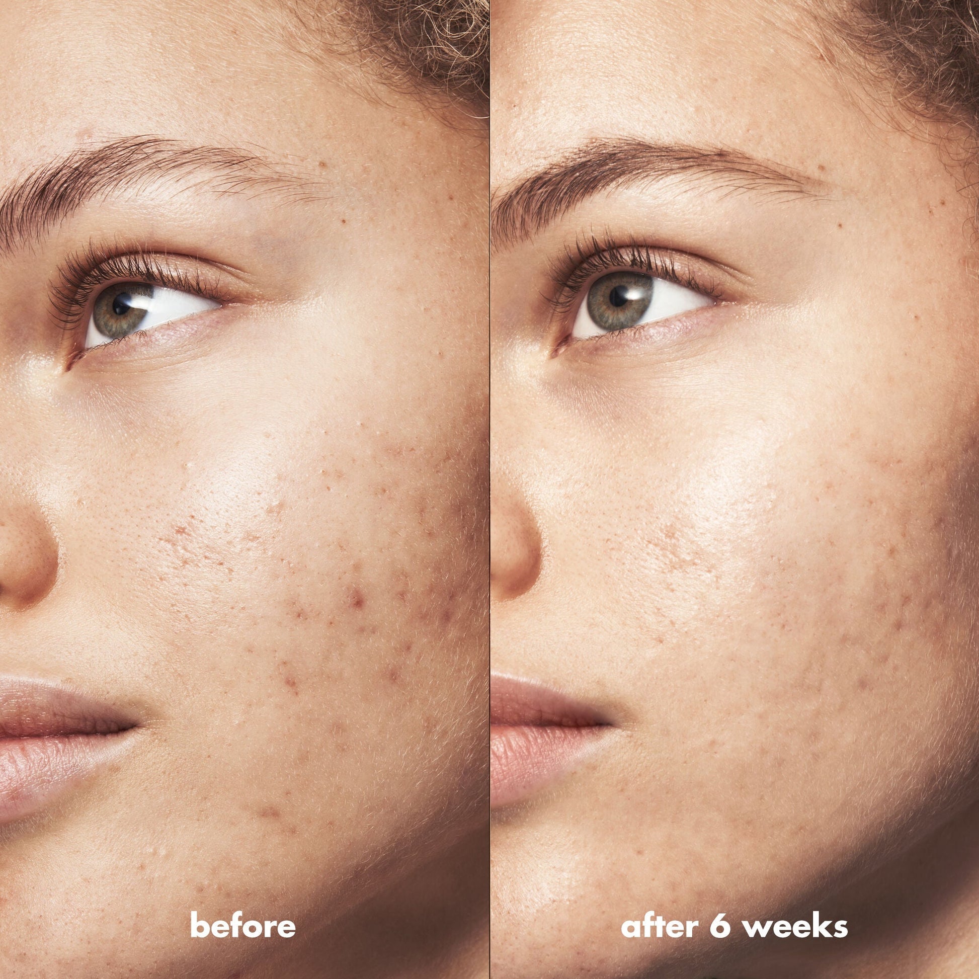 blemish-breakthrough-acne-calming-water-cream-mini-r6 Acne_PDP_Marley_Before_After_acf01478-a58b-47ce-99b5-2ef1dc022f9b.jpg